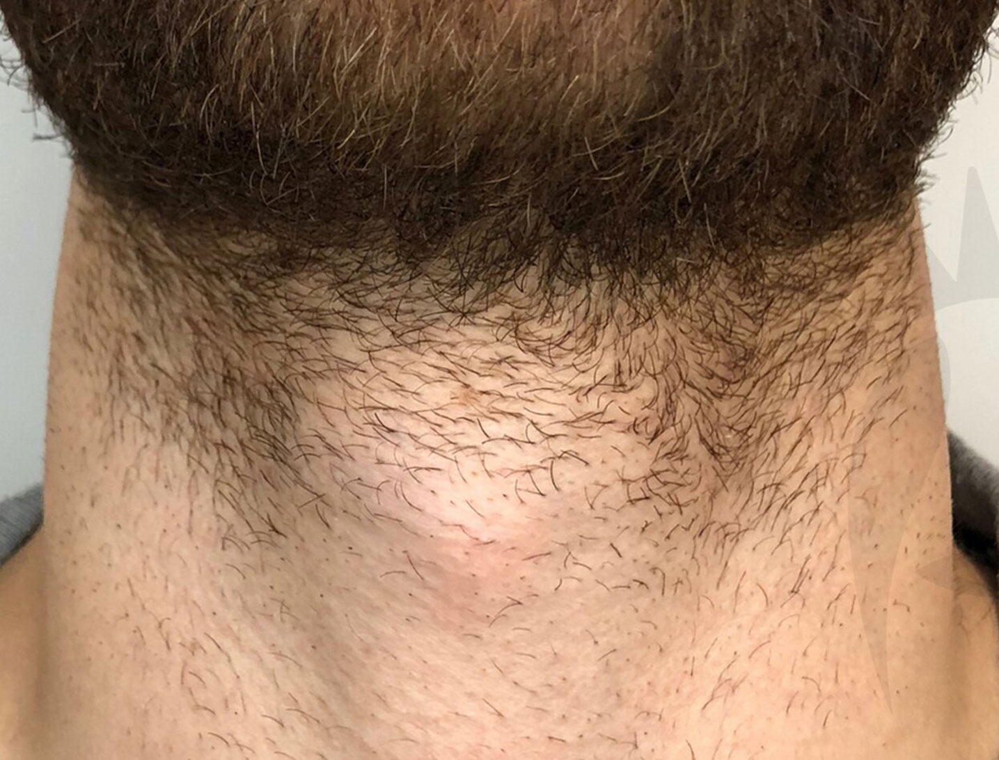 Laser hair removal on a male under his neck line